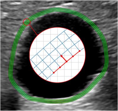 Fast strain mapping in abdominal aortic aneurysm wall reveals heterogeneous patterns